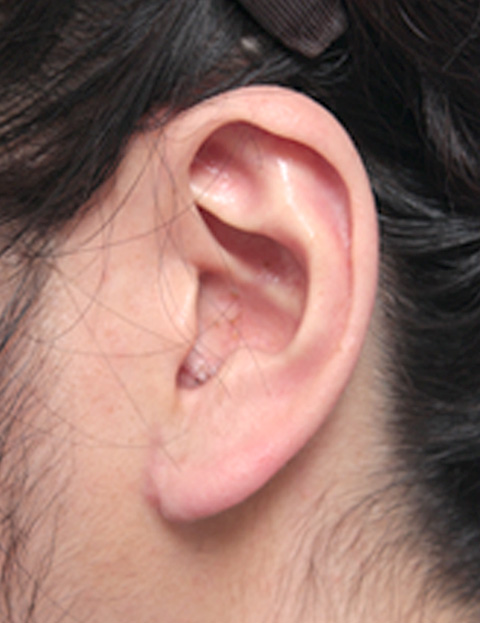 症例写真,耳たぶの縮小手術の症例写真,1週間後,mainpic_mimiother02c.jpg