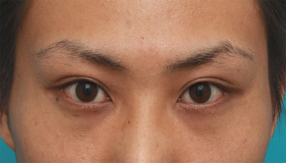 症例写真,男性患者様で、ミニ切開法で幅の狭い平行型二重を作った症例写真,After（6ヶ月後）,ba_mini_sekkai32_b.jpg