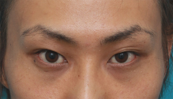 男性患者様で、ミニ切開法で幅の狭い平行型二重を作った症例写真,Before,ba_mini_sekkai32_b.jpg