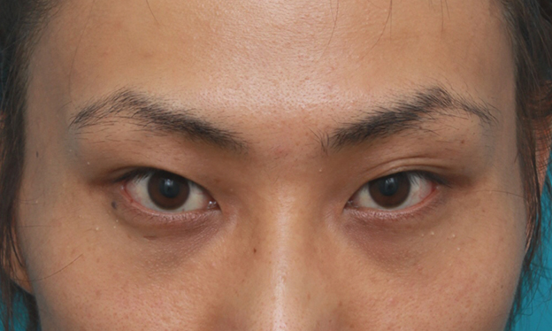 症例写真,男性患者様で、ミニ切開法で幅の狭い平行型二重を作った症例写真,手術前,mainpic_mini_sekkai11a.jpg