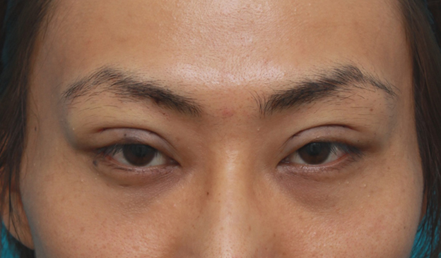 症例写真,男性患者様で、ミニ切開法で幅の狭い平行型二重を作った症例写真,手術直後,目を開けた状態,mainpic_mini_sekkai11b.jpg