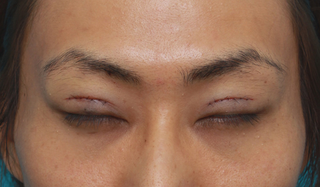 症例写真,男性患者様で、ミニ切開法で幅の狭い平行型二重を作った症例写真,手術直後,目を閉じた状態,mainpic_mini_sekkai11c.jpg