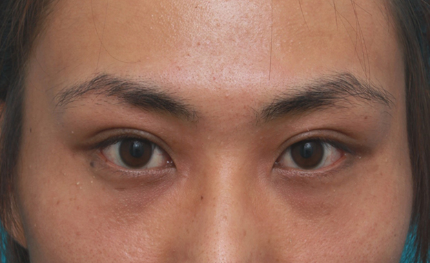 症例写真,男性患者様で、ミニ切開法で幅の狭い平行型二重を作った症例写真,1ヶ月後,目を開けた状態,mainpic_mini_sekkai11f.jpg