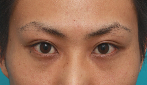 症例写真,男性患者様で、ミニ切開法で幅の狭い平行型二重を作った症例写真,6ヶ月後,目を開けた状態,mainpic_mini_sekkai11h.jpg
