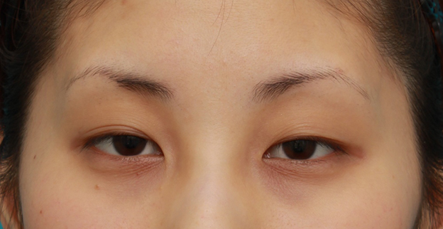 症例写真,患者様の希望でかなり幅の広い平行型二重まぶたをミニ切開法で作った症例写真,手術前,mainpic_mini_sekkai14a.jpg