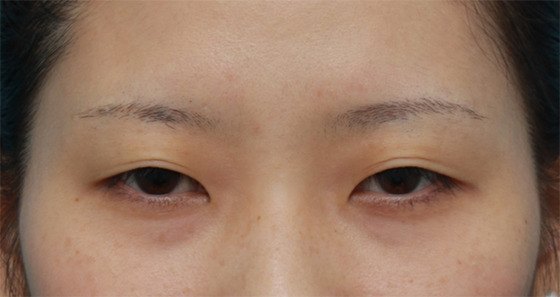 症例写真,目頭切開せずに二重まぶたミニ切開法で幅の狭い平行型二重を作った症例写真,手術前,mainpic_mini_sekkai16a.jpg