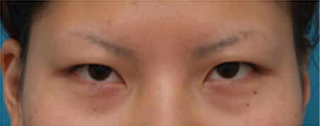片目ずつ全切開二重手術をした症例写真,Before手術前,ba_sekkai15_b.jpg