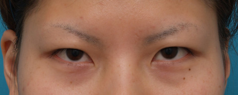 症例写真,片目ずつ全切開二重手術をした症例写真,手術前,mainpic_sekkai09a.jpg