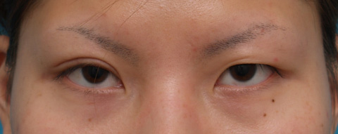 症例写真,片目ずつ全切開二重手術をした症例写真,右目術後1週間,mainpic_sekkai09c.jpg