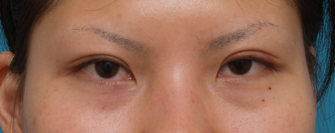 症例写真,片目ずつ全切開二重手術をした症例写真,左目術後1週間,mainpic_sekkai09f.jpg