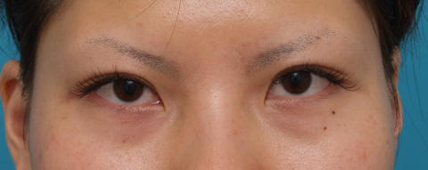 症例写真,片目ずつ全切開二重手術をした症例写真,左目術後4週間,メイクなし,mainpic_sekkai09g.jpg