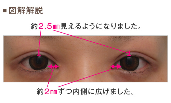 二重の手術のときに 二重の幅を目頭側は広くとか目尻側は狭くとか部分的にこだわる人へメッセージ Dr 高須幹弥の美容整形講座 美容整形の高須クリニック
