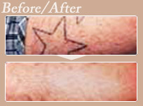 症例写真,刺青（タトゥー）除去の症例　レーザーで除去,After,
