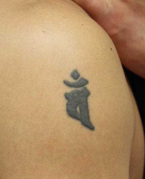 症例写真,刺青（タトゥー）除去　切除縫縮にて除去,施術前,mainpic_irezumi02a.jpg