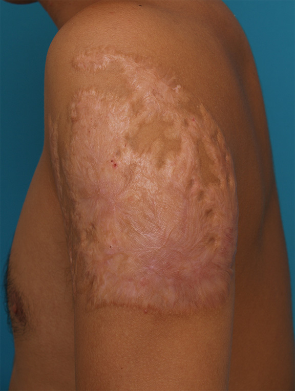 症例写真,肩の大きな入れ墨の剥削手術症例写真,After（剥削後2年）,ba_irezumi12_b.jpg