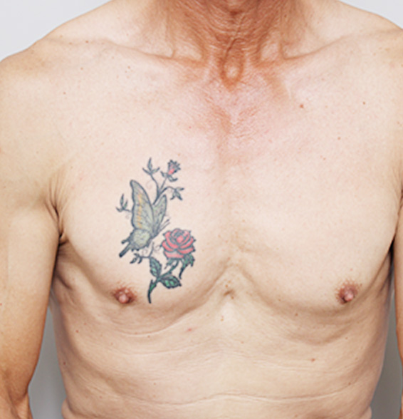 症例写真,刺青（タトゥー）除去の症例 胸に入れ墨があった男性,Before,ba_irezumi14_b.jpg