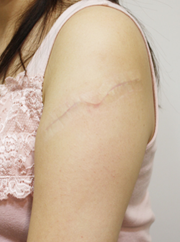 症例写真,刺青（タトゥー）除去　切除縫縮にて除去,After(1ヶ月後),ba_irezumi05_b.jpg