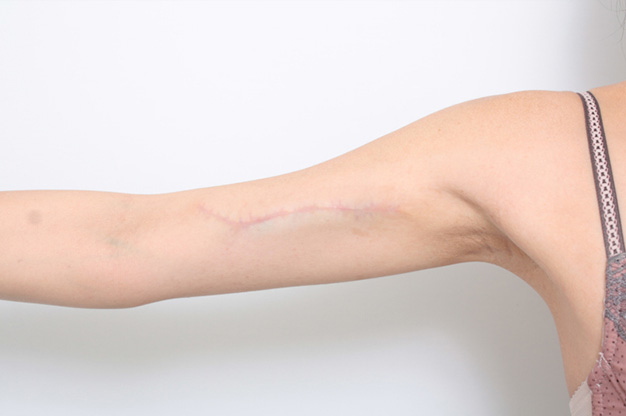 症例写真,2回に分けて切除縫縮した二の腕の入れ墨の症例写真,After（2回目手術後6ヶ月）,ba_irezumi21_b.jpg