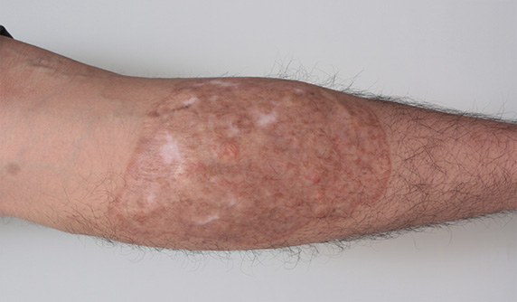 巨大なふくらはぎの刺青を剥削手術で完全除去した症例写真,After（1年6ヶ月後）,ba_irezumi23_a01.jpg
