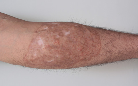 症例写真,巨大なふくらはぎの刺青を剥削手術で完全除去した症例写真,1年6ヶ月後,mainpic_irezumi10f.jpg
