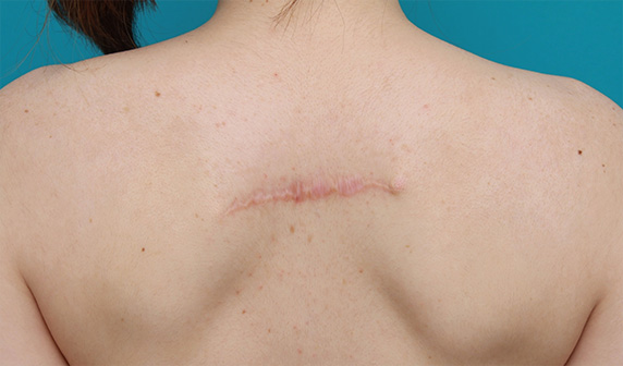 症例写真,背中の入れ墨を2回に分けて切除縫縮した症例写真,After（2回目手術後6ヶ月）,ba_irezumi25_b.jpg