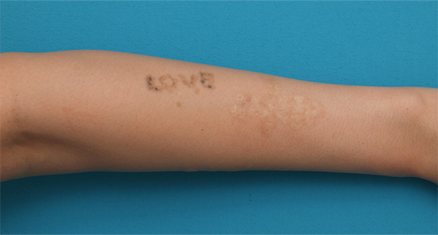 症例写真,腕に墨汁で入れた刺青にレーザー治療した症例写真,1回目照射後2ヶ月,mainpic_irezumi13c.jpg