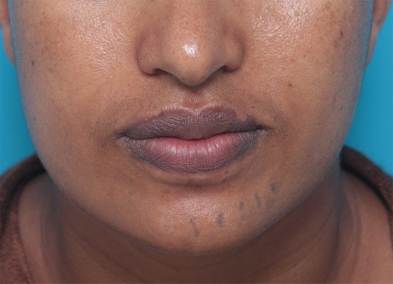 症例写真,アフリカの黒人女性の顔面の入れ墨にレーザー治療した症例写真,After（4回目照射後2ヶ月）,ba_irezumi27_b.jpg