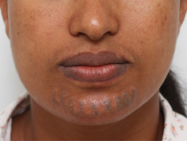 症例写真,アフリカの黒人女性の顔面の入れ墨にレーザー治療した症例写真,治療直後,mainpic_irezumi14b.jpg