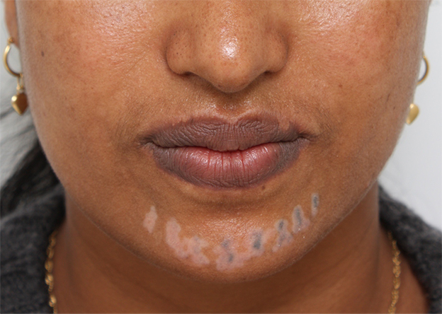 症例写真,アフリカの黒人女性の顔面の入れ墨にレーザー治療した症例写真,2回目照射後1週間,mainpic_irezumi14e.jpg
