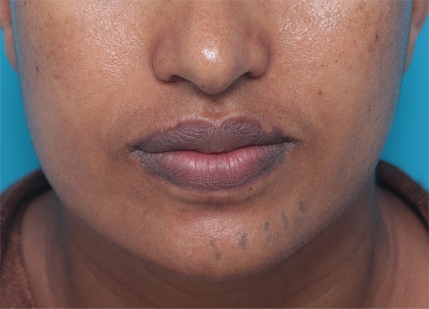 症例写真,アフリカの黒人女性の顔面の入れ墨にレーザー治療した症例写真,4回目照射後2ヶ月,mainpic_irezumi14h.jpg