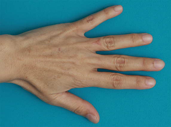 指に入れた入れ墨を剥削手術で除去した症例写真,After（5ヶ月後）,ba_irezumi29_a01.jpg