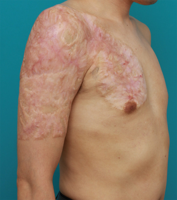 症例写真,胸~肩~上腕にかけての広範囲の刺青を3回に分けて剥削手術で除去した症例写真,After（3回目手術後2年）,ba_irezumi31_b.jpg