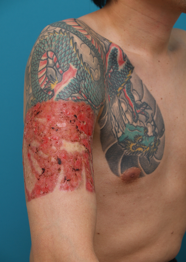 症例写真,胸~肩~上腕にかけての広範囲の刺青を3回に分けて剥削手術で除去した症例写真,1回目手術後1ヶ月,mainpic_irezumi17c.jpg