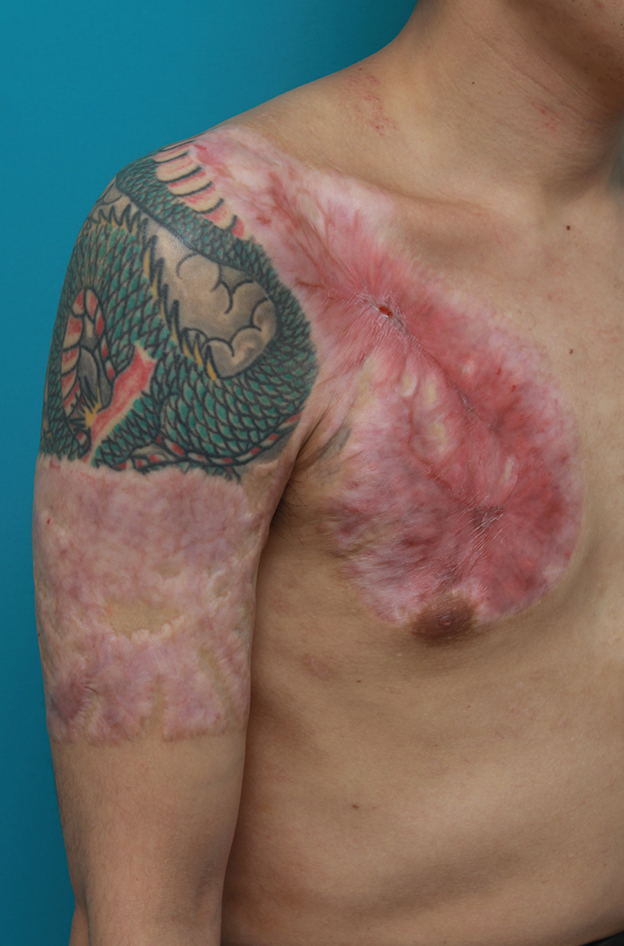 症例写真,胸~肩~上腕にかけての広範囲の刺青を3回に分けて剥削手術で除去した症例写真,2回目手術後10ヶ月,mainpic_irezumi17f.jpg