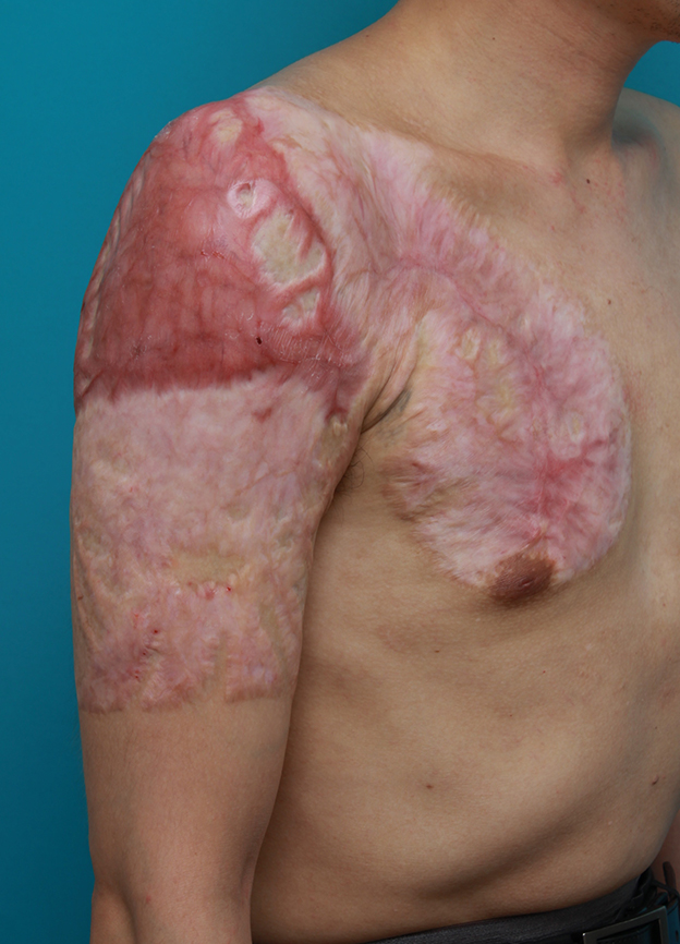 症例写真,胸~肩~上腕にかけての広範囲の刺青を3回に分けて剥削手術で除去した症例写真,3回目手術後6ヶ月,mainpic_irezumi17i.jpg
