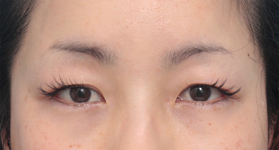 症例写真,患者様の希望で、かなり幅の広い平行型二重を全切開法で作った症例写真,Before,ba_sekkai33_b.jpg