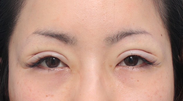 症例写真,患者様の希望で、かなり幅の広い平行型二重を全切開法で作った症例写真,手術直後,mainpic_sekkai16b.jpg