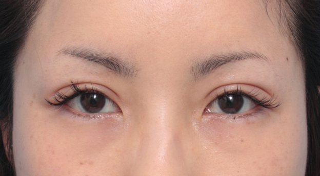 症例写真,患者様の希望で、かなり幅の広い平行型二重を全切開法で作った症例写真,1ヶ月後,mainpic_sekkai16d.jpg