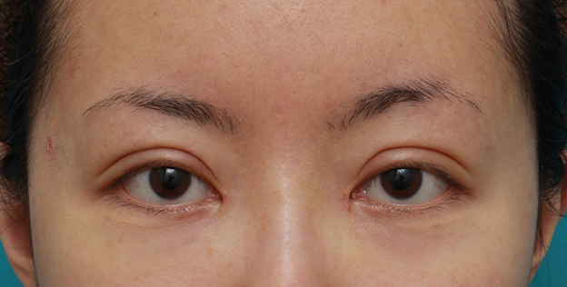症例写真,他院で行われたくい込みの弱い二重まぶた切開法を、修正手術で幅を広げて、尚且つ、くい込みを強くし、目頭切開も行った症例写真,1週間後,mainpic_modify02c.jpg