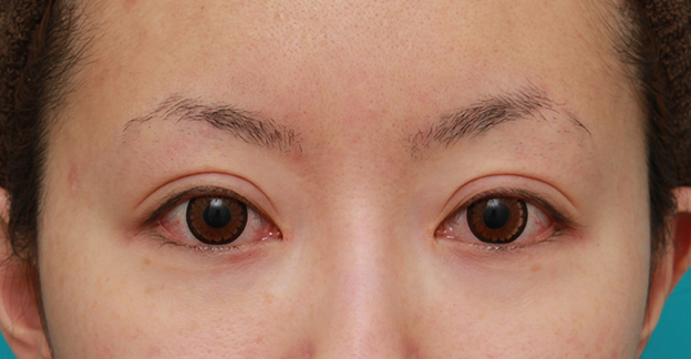 症例写真,他院で行われたくい込みの弱い二重まぶた切開法を、修正手術で幅を広げて、尚且つ、くい込みを強くし、目頭切開も行った症例写真,6ヶ月後,カラコンあり,mainpic_modify02g.jpg