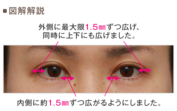 二重まぶたミニ切開法 目頭切開 目尻切開 タレ目形成を同時に行った症例写真 美容整形の高須クリニック 東京赤坂 横浜 名古屋 大阪 二重まぶたミニ切開法 目頭切開 目尻切開 タレ目形成を同時に行った症例写真 美容整形の高須クリニック 東京赤坂 横浜 名古屋 大阪