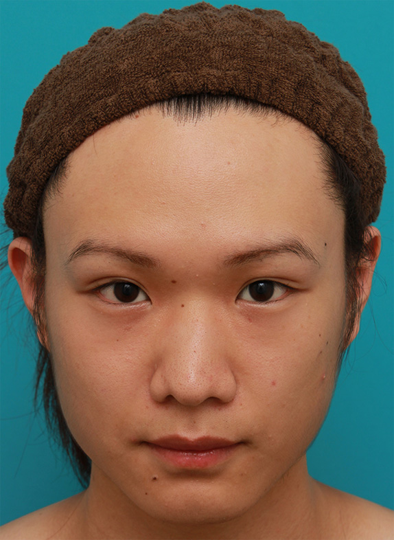 症例写真,全切開法で幅の広い平行型二重まぶたを作った男性の症例写真,After（目を開けた状態）,ba_sekkai46_b.jpg