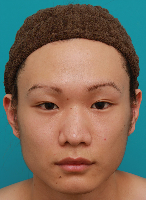 全切開法で幅の広い平行型二重まぶたを作った男性の症例写真,Before,ba_sekkai46_b.jpg