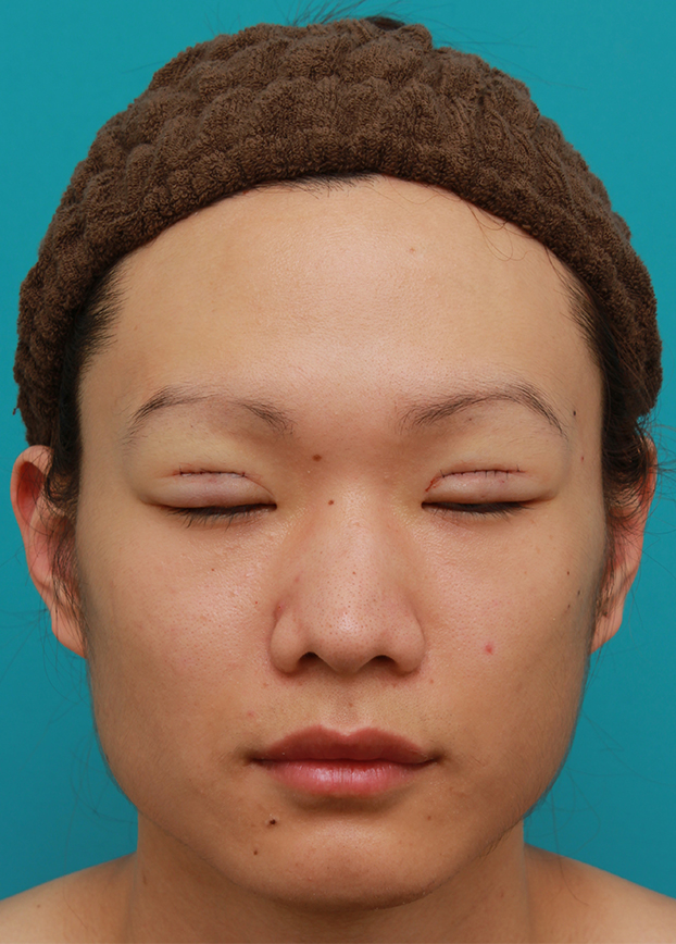 症例写真,全切開法で幅の広い平行型二重まぶたを作った男性の症例写真,手術直後,目を閉じた状態,mainpic_sekkai25c.jpg