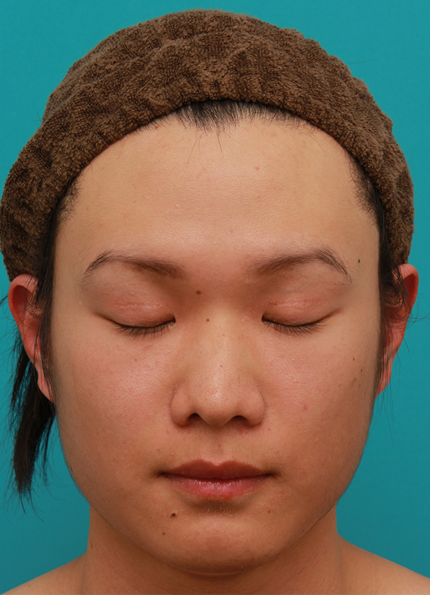 症例写真,全切開法で幅の広い平行型二重まぶたを作った男性の症例写真,1ヶ月後,目を閉じた状態,mainpic_sekkai25g.jpg