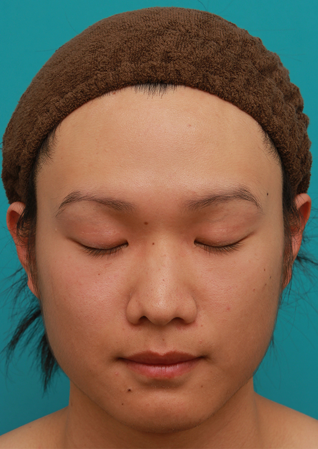 症例写真,全切開法で幅の広い平行型二重まぶたを作った男性の症例写真,6ヶ月後,目を閉じた状態,mainpic_sekkai25i.jpg
