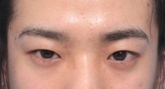 症例写真,二重まぶたミニ切開法で自然な末広型を作った男性患者様の症例写真,Before,ba_mini_sekkai42_b.jpg