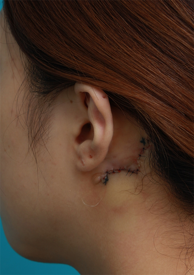 症例写真,耳の後ろの入れ墨を部分的に切除縫縮手術して除去した症例写真,手術直後,mainpic_irezumi18b.jpg