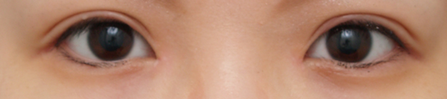 症例写真,目頭切開の症例 Z法で蒙古ひだを切開しひと回り目を大きくした女性,1ヶ月後,mainpic_megashira01c.jpg