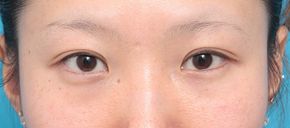 目頭切開の症例 蒙古襞が発達して目と目が離れていた20代女性,Before,ba_megashira19_b.jpg